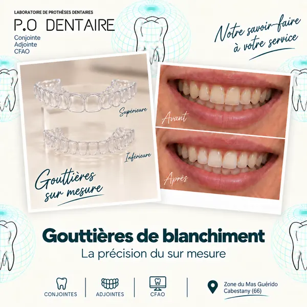 Gouttières de blanchiment